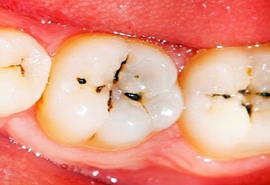 what does a cavity look like